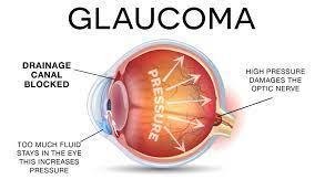 Understanding Glaucoma: The Stealthy Vision Thief
