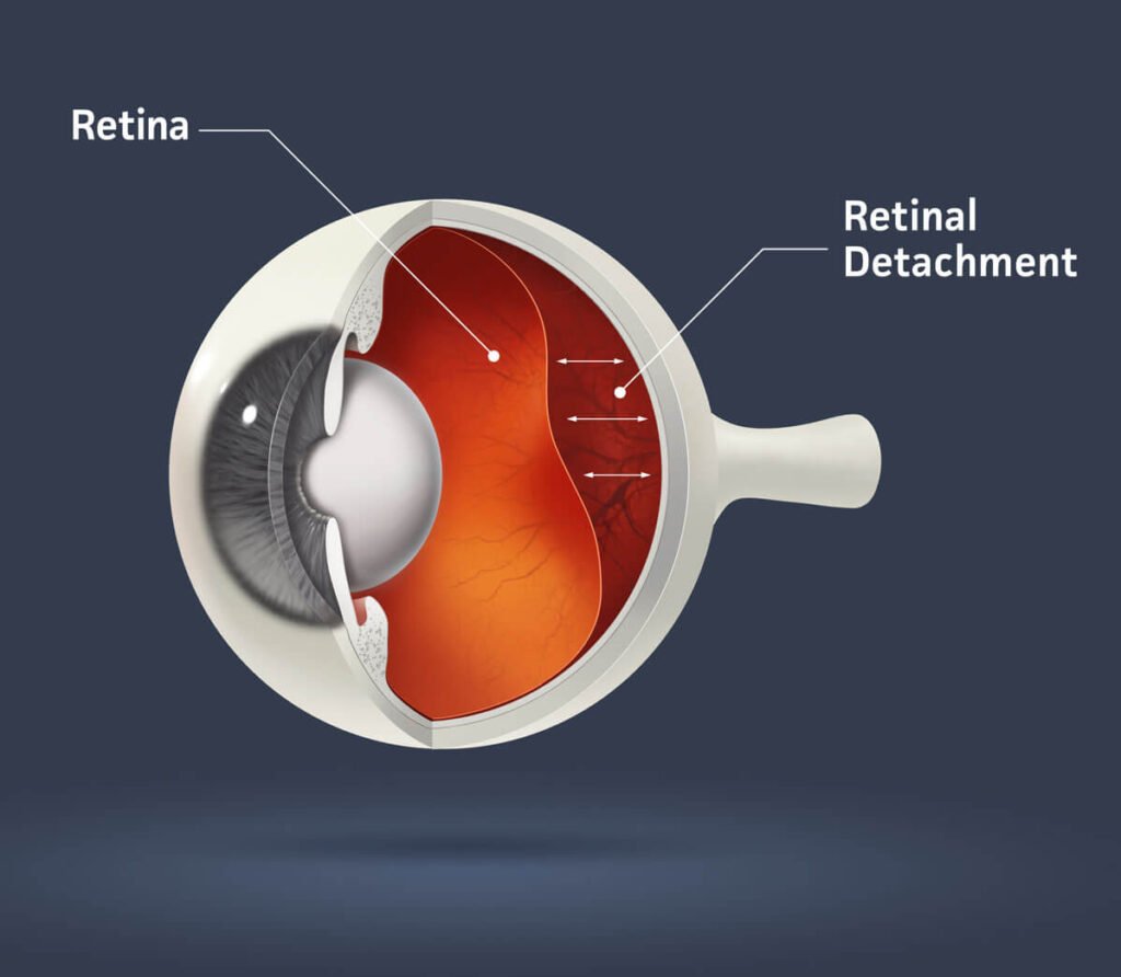 Retina Evaluation