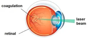 The Best Retina Treatments for Diabetic Patients