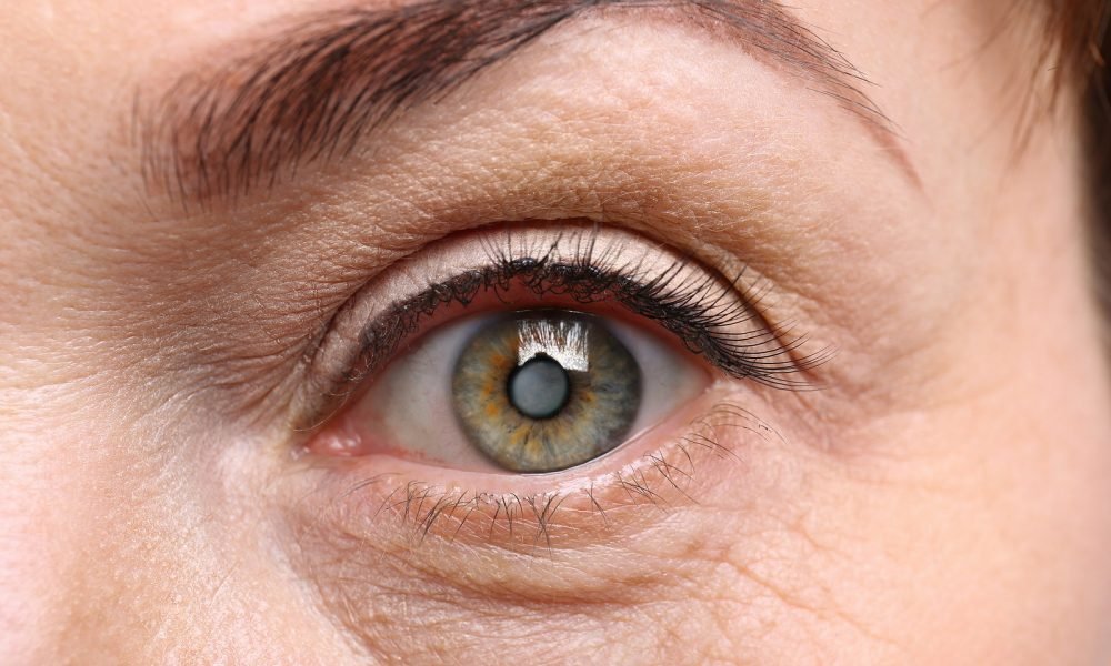 Cataract-Condition-From-Diabetes